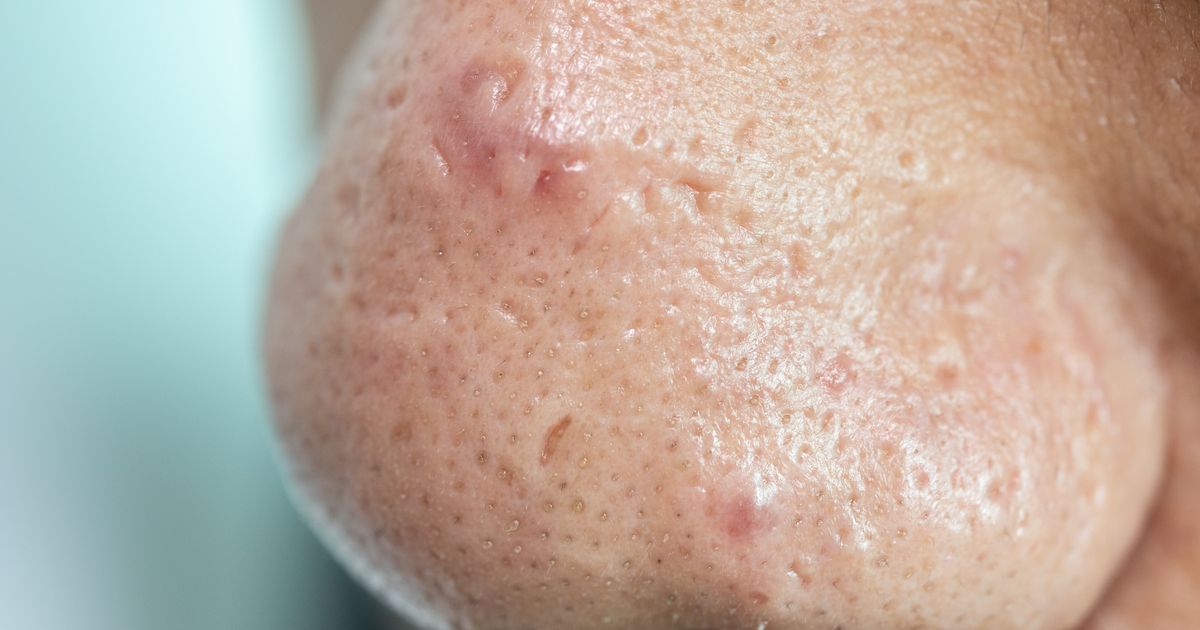 How To Tell Normal Spots Vs Skin Cancer